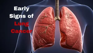 Early Signs of Lung Cancer Symptoms You Shouldn’t Ignore